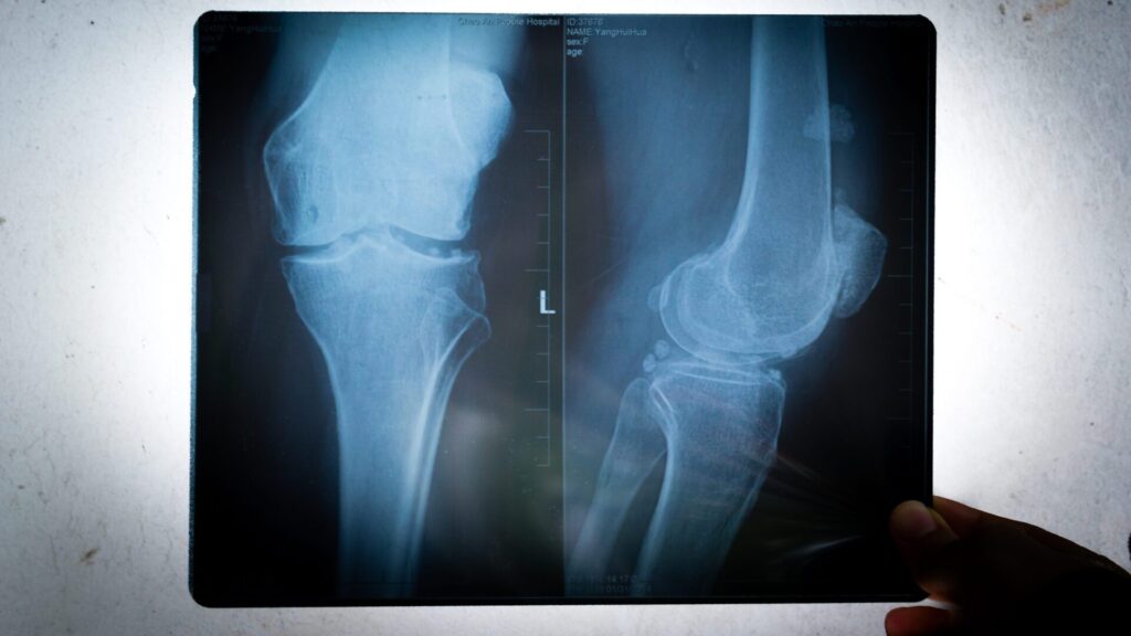 The principle that led to the introduction of the X-ray was discovered by Wilhelm Röntgen by accident.